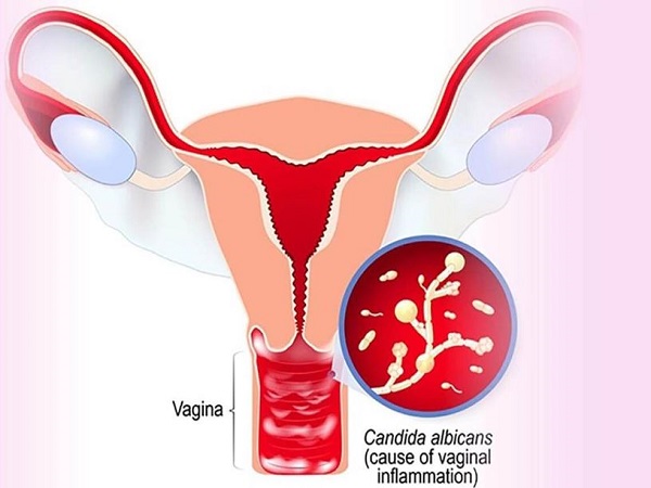 Kiểm soát tốt lượng đường trong máu là cách ngăn ngừa nấm âm đạo