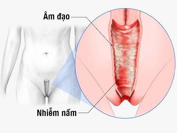 Nấm âm đạo là gì?