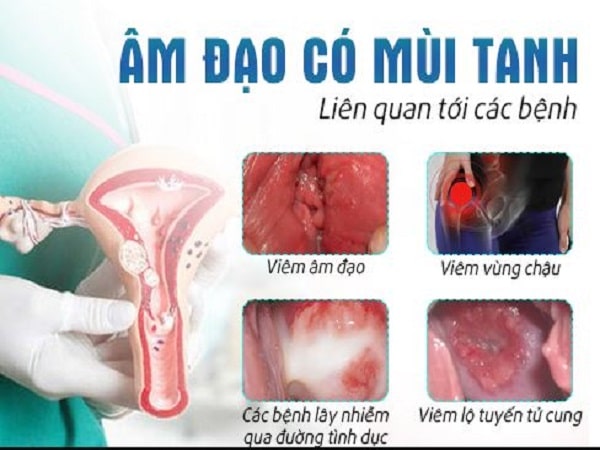 Mùi tanh – Cảnh báo viêm âm đạo do vi khuẩn