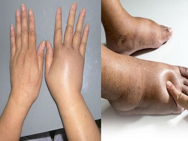 Phù chân – dấu hiệu của bệnh tim, thận hoặc gan
