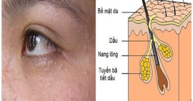 cách trị mụn thịt
