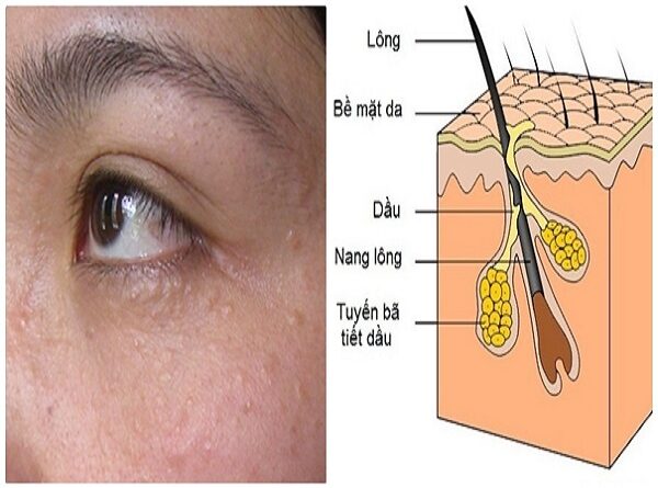 cách trị mụn thịt