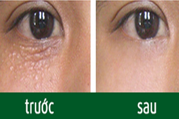 Cách trị mụn thịt hiệu quả
