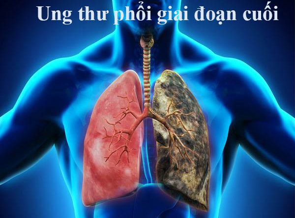 Các triệu chứng ung thư phổi giai đoạn cuối cần biết