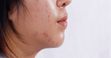 Da dầu là gì? Nguyên nhân nào dẫn đến tình trạng này