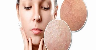 Mụn ẩn là gì? Một số biện pháp phòng ngừa tình trạng này
