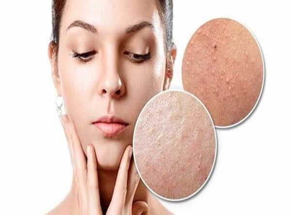Mụn ẩn là gì? Một số biện pháp phòng ngừa tình trạng này