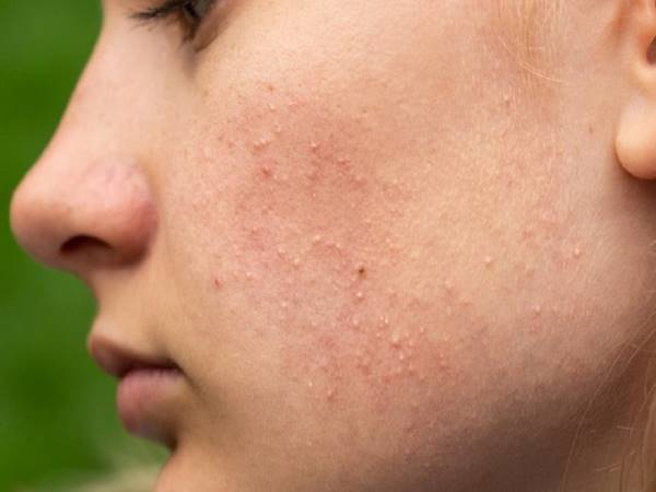 Một số biện pháp phòng ngừa mụn ẩn