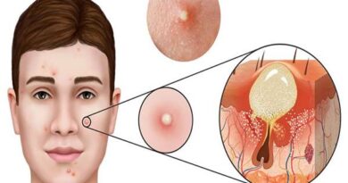 Mụn là gì? Làm thế nào để phòng tránh mụn ghé thăm