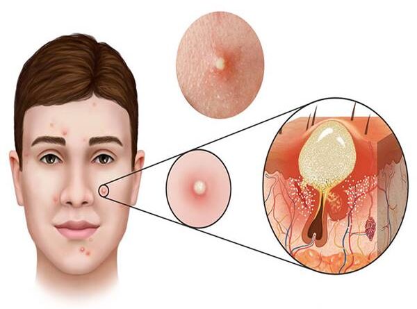 Mụn là gì? Làm thế nào để phòng tránh mụn ghé thăm