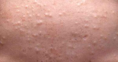 cách trị mụn ẩn tại nhà
