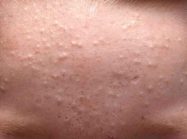 cách trị mụn ẩn tại nhà