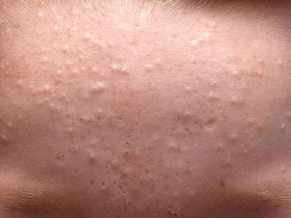 Mụn ẩn là gì?