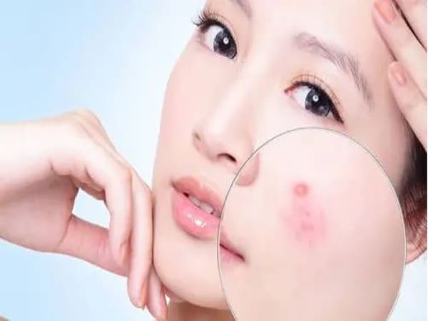 Hiểu về tình trạng da mụn
