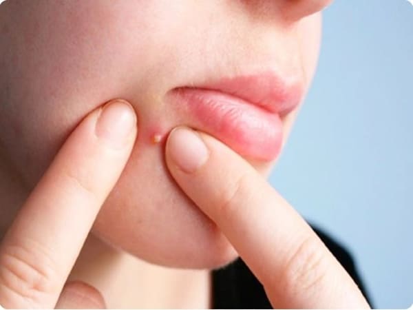 Những điều cần lưu ý khi nặn mụn