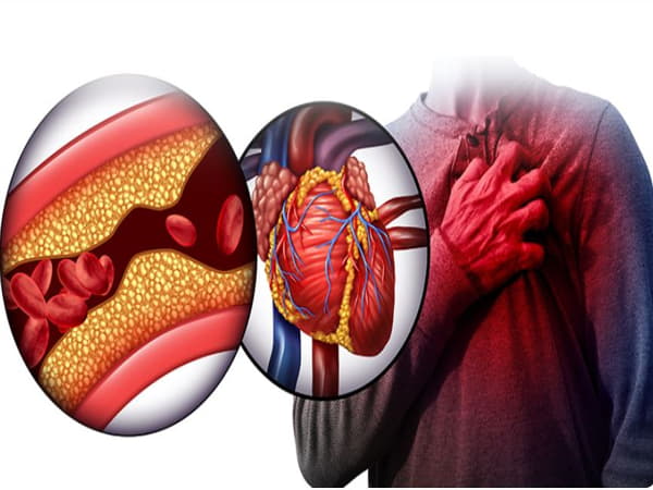 Mỡ máu là gì và tại sao cần kiểm soát